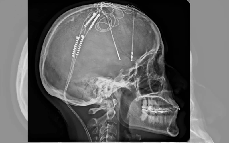 Cirugía pionera en Colombia: HIC implanta cuatro electrodos para tratar depresión.